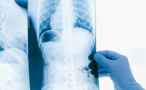 A világon egyedülálló műtéti eljárást találtak fel Szegeden